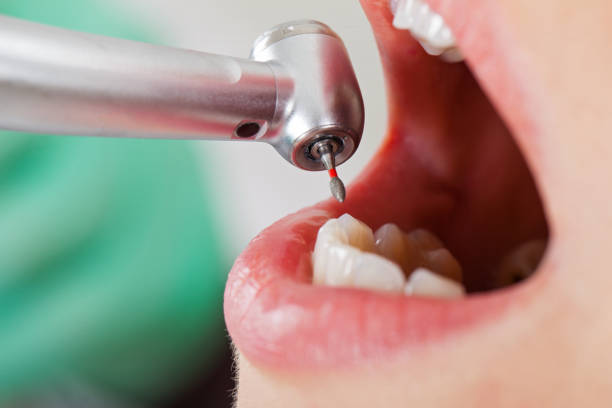 Best Emergency Tooth Extraction in Cumberland Head, NY